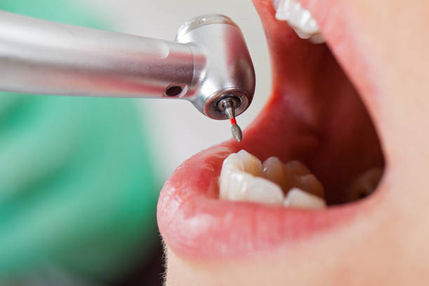 Best Urgent Care for Lost Fillings or Crowns in Thermopolis, WY